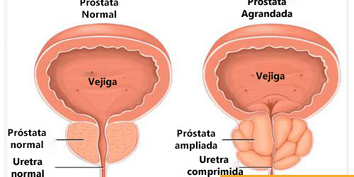 Agrandamiento de la próstata: Qué es y cómo identificarlo