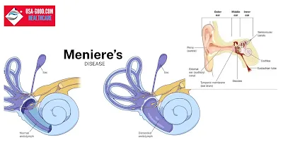What is Meniere's disease?