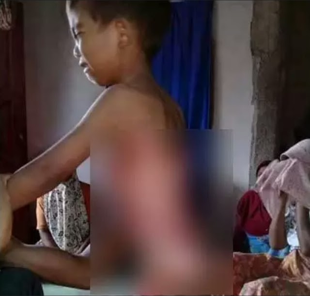 VIRAL! Bocah 6 Tahun asal Lombok Luka Parah Usai Tercebur ke Panci Berisi Air Panas