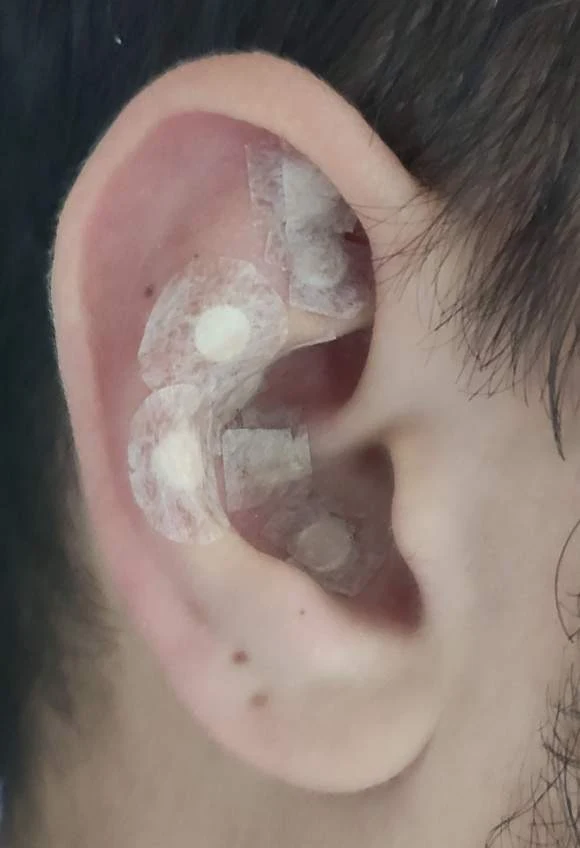 Auriculoterapia-com-Stiper