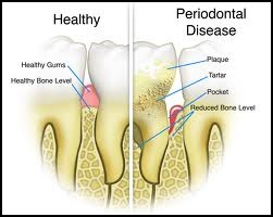 All On 4 Implant