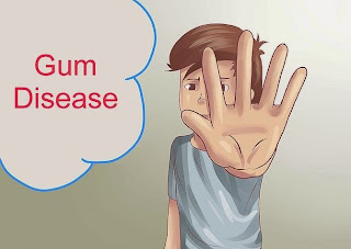 Causes of Gingivitis (Gum Inflammation) part 2