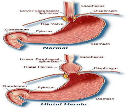 symptoms of hiatal hernia it is accompanied by symptoms like
