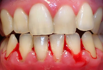  Nguyên nhân gây viêm chân răng có mủ