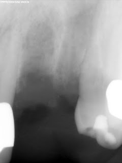 Alveolar morphology of #10, #11 showing alveolar atrophy with odontogenic etiology and relationship of restorative space