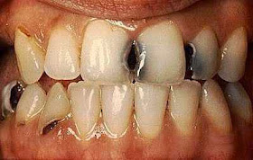 5 Tips dan Cara Perawatan Gigi Berlubang Cara Merawat Gigi Berlubang Ilustrasi Memiliki Gigi yang Berlubang