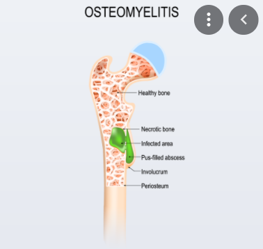 Infection of Bone (Osteomyelitis)