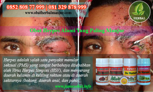 cara menyembuhkan herpes