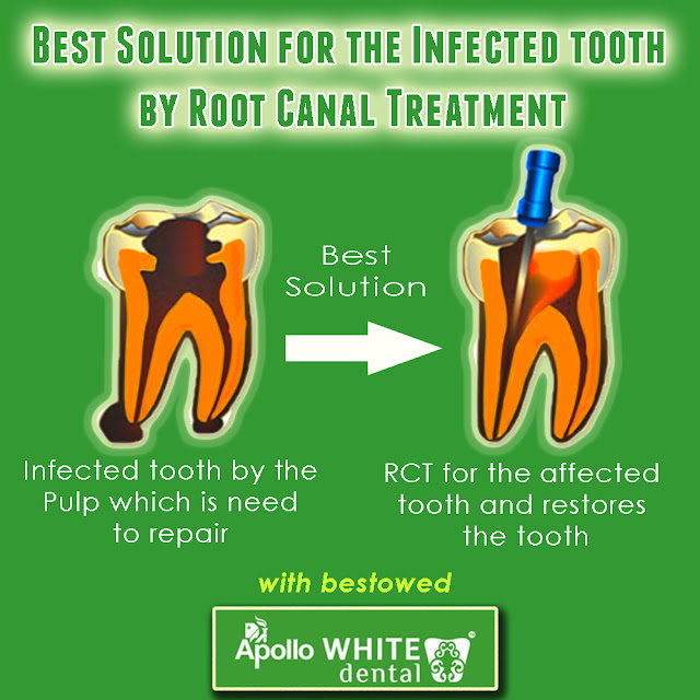 Best Solution for the Infected tooth by Root Canal Treatment