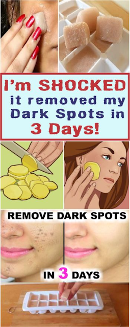 I’m SHOCKED it removed my Dark Spots in 3 Days, Potato & lemon juice icecubes