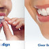 Niềng răng chỉnh nha Invisalign