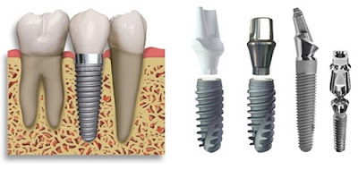 cấy ghép răng với implant