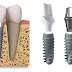 Cấy ghép răng với implant