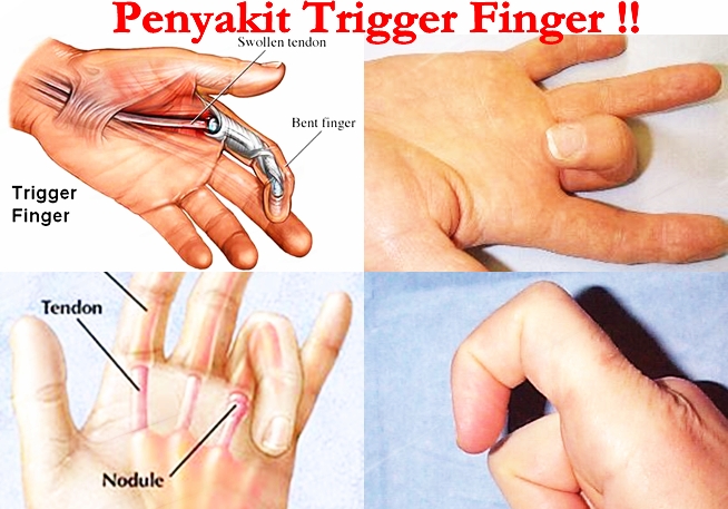 Pengobatan Tradisional Trigger Finger