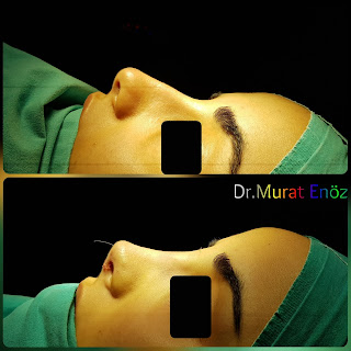 Micromotor Assisted Rhinoplasty, Nose Job Istanbul,Female Nose Aesthetic Turkey,