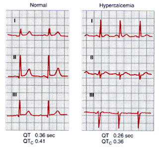 ECG changes in Acute Hypercalcemia