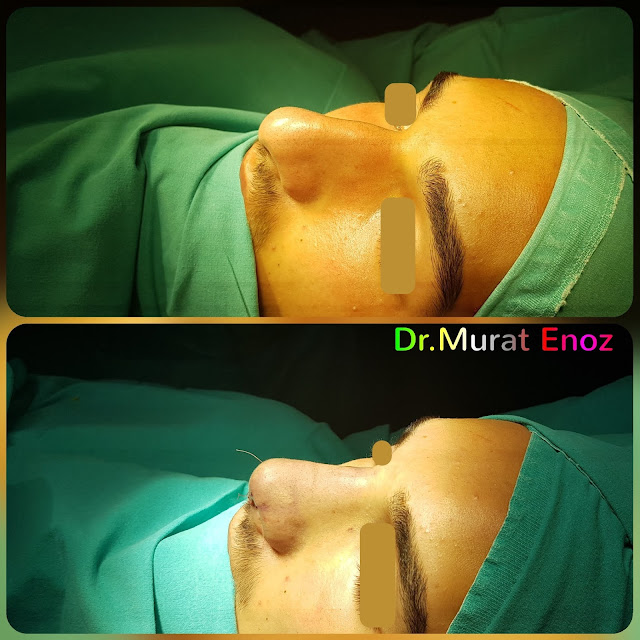 Male Nose Aesthetic Surgery in Turkey, Men's Rhinoplasty in Istanbul,Nose Job in Male Patient, Rhinoplasty in Men Istanbul,