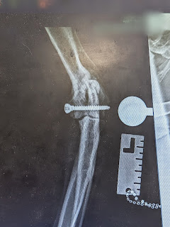 A black and white photo of the x-ray taken of Boris's elbow showing the screw use to stabilise the fracture in his elbow