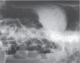 Imagens de Raio x de abdome agudo decúbito lateral com raios horizontais