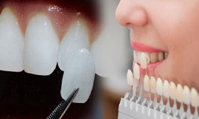  Bọc răng sứ cho răng sâu có tốt không?
