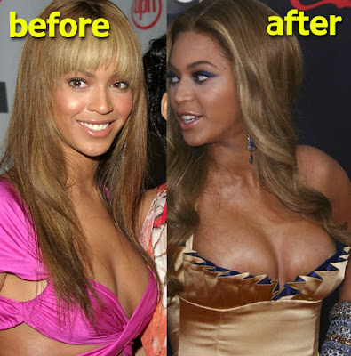 Beyonce Breast Implants
