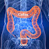 Early Stages of Colon Cancer Symptoms