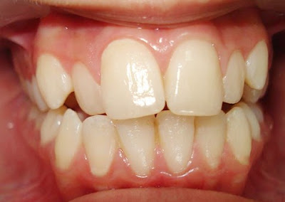 Nguyên nhân khiến răng hô là gì