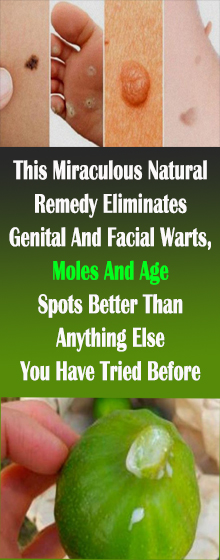 This Miraculous Natural Remedy Eliminates Genital And Facial Warts, Moles And Age Spots Better Than Anything Else You Have Tried Before #HealthRemedies