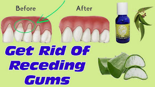 Some of the natural remedies for gum disease picture