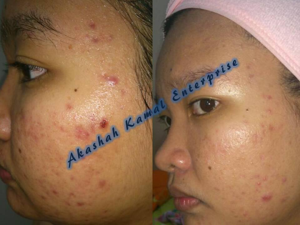 Testimoni ~ Zarraz Paramedical