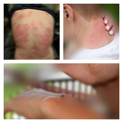 mosquito bites