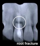 root fracture of maxillary incisor