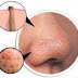  Blackheads - Natural Home Remedies 