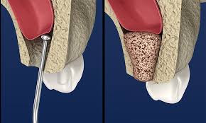 ental Membrane and Bone Graft Substitutes