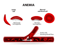 One-Time, Lasting Treatment for Sickle Cell Disease