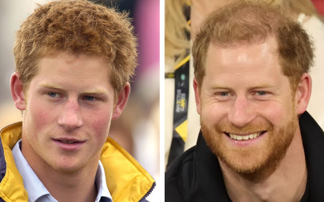 Prince Harry hair loss