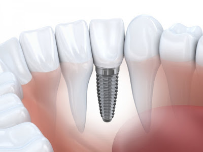 Yếu tố nào ảnh hưởng đến chi phí cấy ghép Implant?