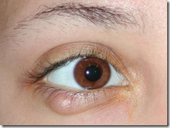 chalazion