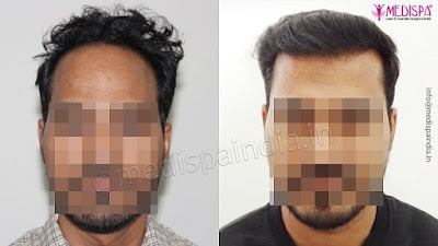 Hair transplant in Gurgaon