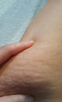 Cellulite treatment 1 week