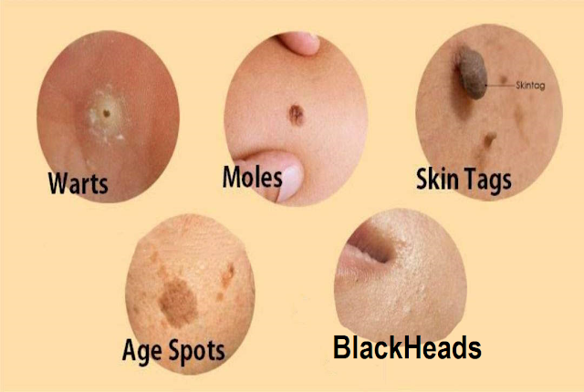 Tips on How To Naturally Cure Skin Tags, Moles, Warts, Blackheads, And Age Spots