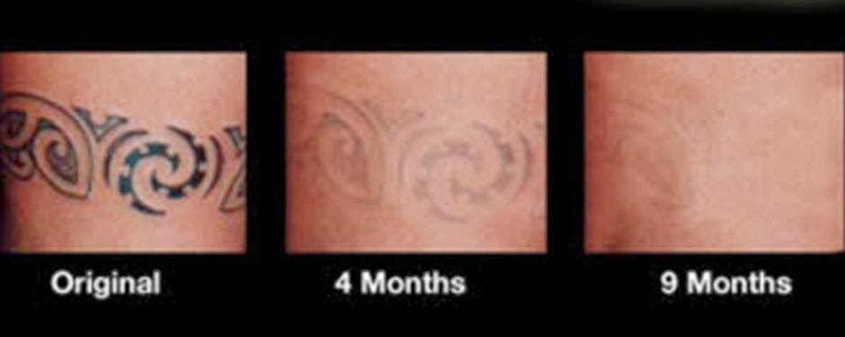 Best Laser Cream Tattoo Removal Reviews | get rid of tattoos at home