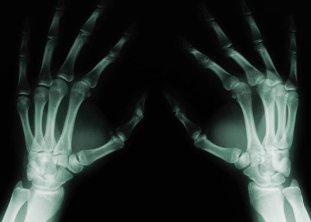 Simponi (Rheumatoid Arthritis) Forecast and Market Analysis