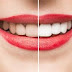  Giải quyết các khuyết điểm màu trên răng