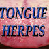 Herpes On Tongue: Causes, Symptoms And Guaranteed Natural Treatment