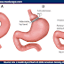 Bariatric Surgery In Mexico Is Becoming A Popular Choice