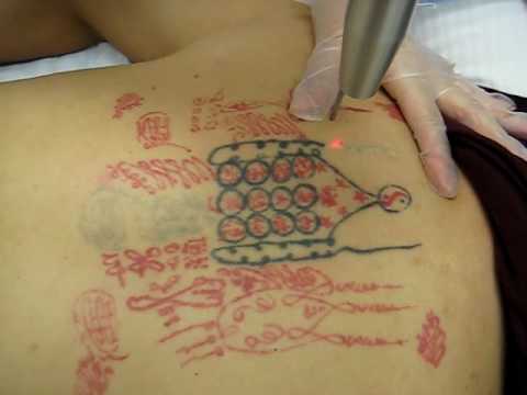 Best Tattoo Designs for Effective Tattooing: Laser Tattoo Removal Cost