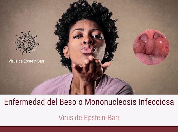 Enfermedad del Beso o Mononucleosis Infecciosa 