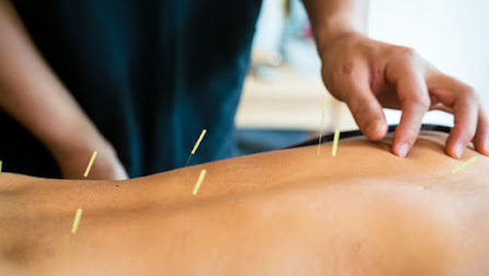 Acupuncture Treatment Hemel Hempstead