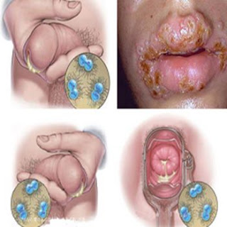 Kencing Nanah Kronis, ciri sipilis wanita, sifilis menular melalui, merk obat gonore (kemaluan bernanah) di apotik, obat pembunuh bakteri gonore (kemaluan keluar nanah), kencing nanah dan sipilis